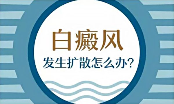 如何遏制初期白癜风的扩散?